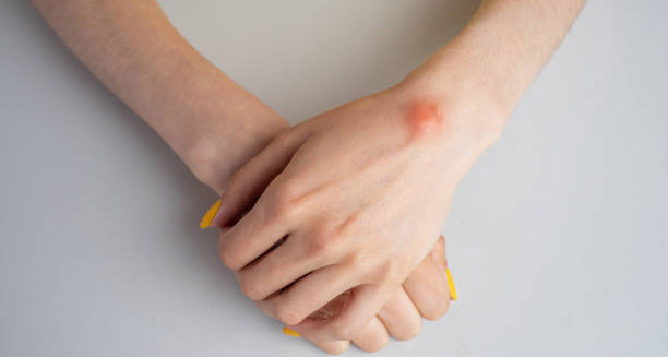 Complications of Lipoma