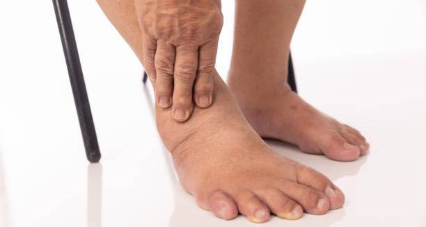 Complications of Lymphoedema