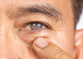 Complications of Macular Degeneration