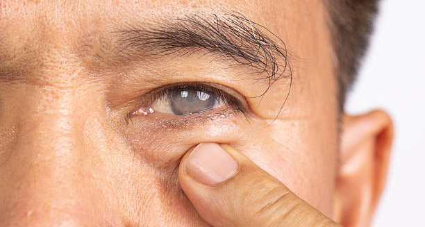 Complications of Macular Degeneration