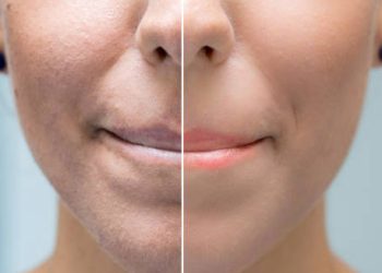 Before and after comparison of facial skin affected by keratosis pilaris