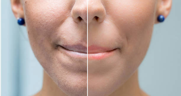 Before and after comparison of facial skin affected by keratosis pilaris