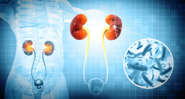 Medical illustration showing kidney infection diagnosis with bacteria magnification