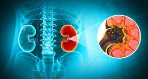 Medical illustration showing kidney stones with diagnostic focus and anatomical overlay