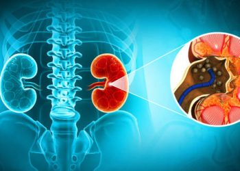 Medical illustration showing kidney stones with diagnostic focus and anatomical overlay