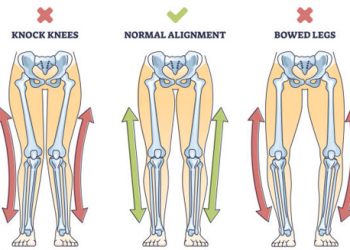 Diagnosis of Knock Knees