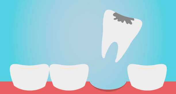 Diagnosis of Knocked-Out Tooth