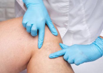 Diagnosis of Leg Ulcer