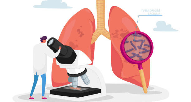 Diagnosis of Legionnaires' Disease