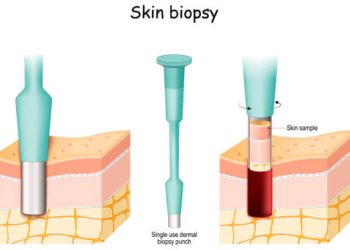 Diagnosis of Leprosy