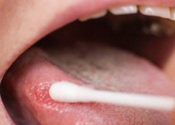 Diagnosis of Leukoplakia