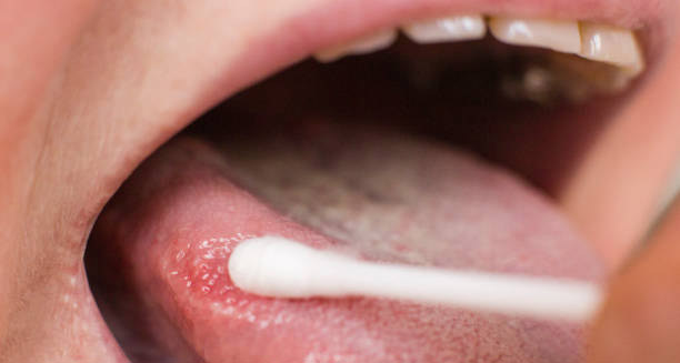 Diagnosis of Leukoplakia