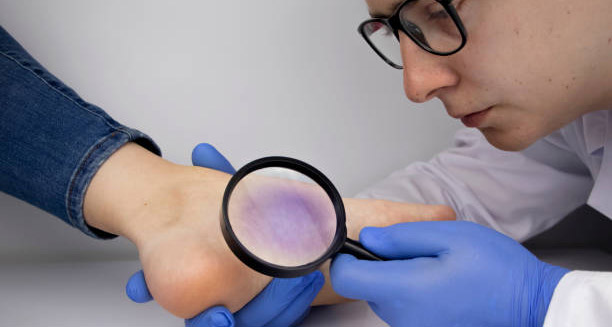 Diagnosis of Lichen Planus