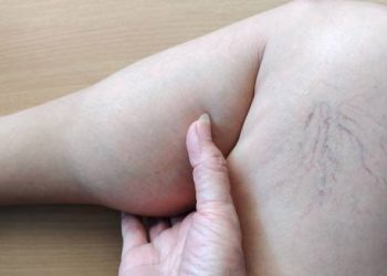 Diagnosis of Lipoedema