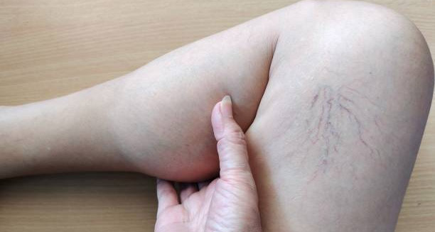 Diagnosis of Lipoedema