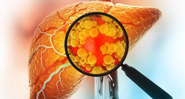 Diagnosis of Liver Cancer