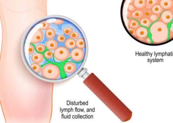 Diagnosis of Lymphoedema