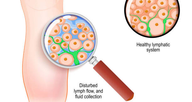 Diagnosis of Lymphoedema