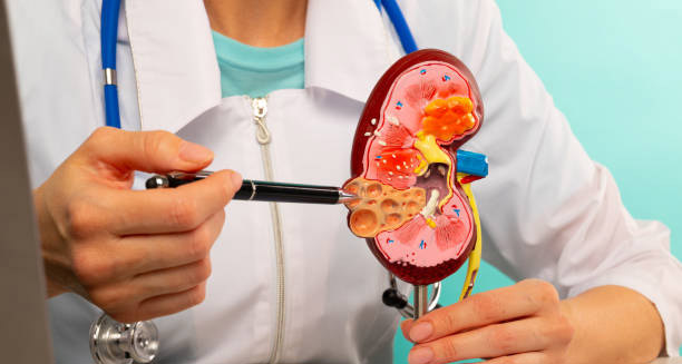 Doctor explaining kidney stones using anatomical kidney model