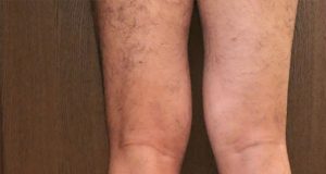Overview of Knock Knees