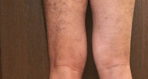 Overview of Knock Knees