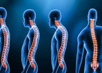 Overview of Kyphosis