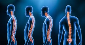 Causes of Kyphosis