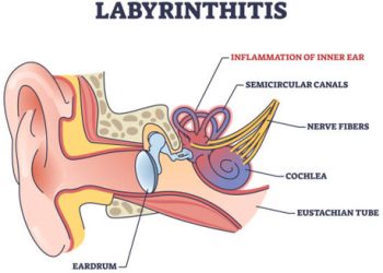 Overview of Labyrinthitis