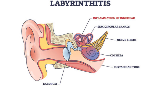 Overview of Labyrinthitis