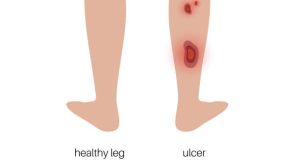 Overview of Leg Ulcer