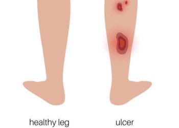 Overview of Leg Ulcer