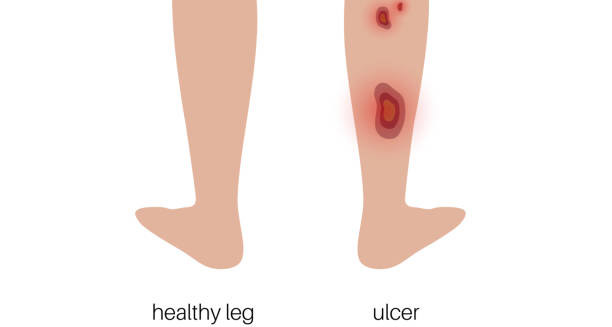Overview of Leg Ulcer