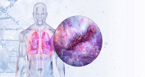 Overview of Legionnaires' Disease