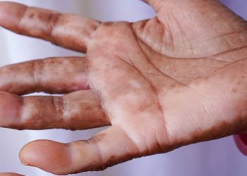 Overview of Leprosy