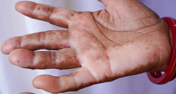 Overview of Leprosy