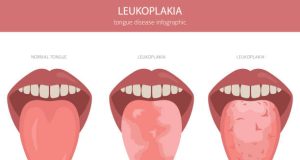 Overview of Leukoplakia