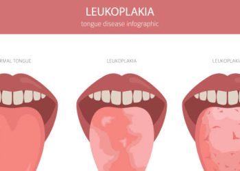 Overview of Leukoplakia