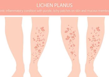 Overview of Lichen Planus