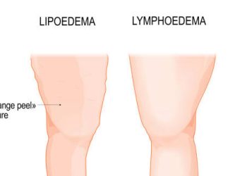 Overview of Lipoedema