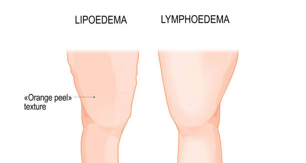Overview of Lipoedema