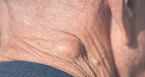 Overview of Lipoma