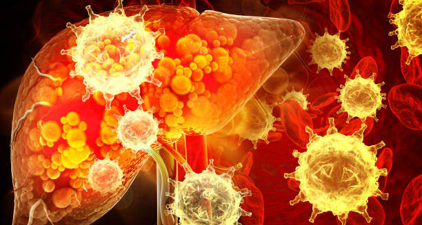 Overview of Liver Cancer