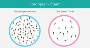 Overview of Low Sperm Count