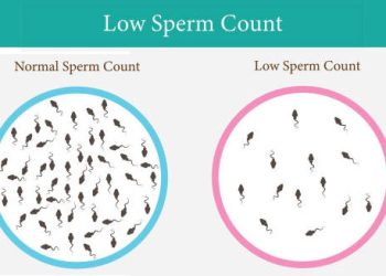 Overview of Low Sperm Count