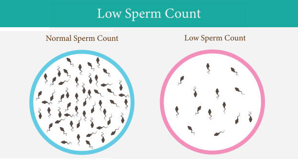 Overview of Low Sperm Count