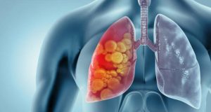Overview of Lung Cancer