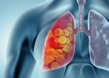 Overview of Lung Cancer