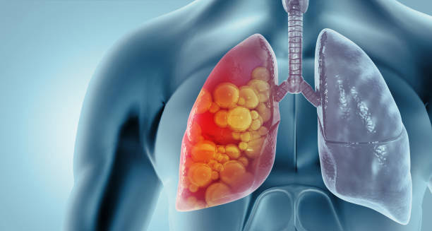 Overview of Lung Cancer