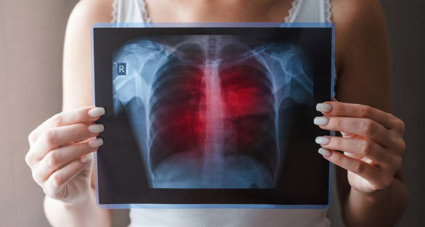 Overview of Lung Disease