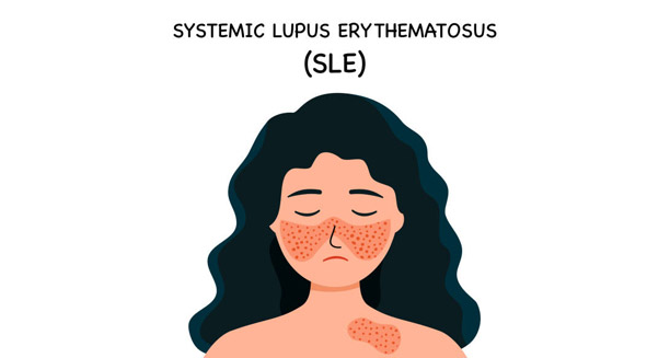 Overview of Lupus
